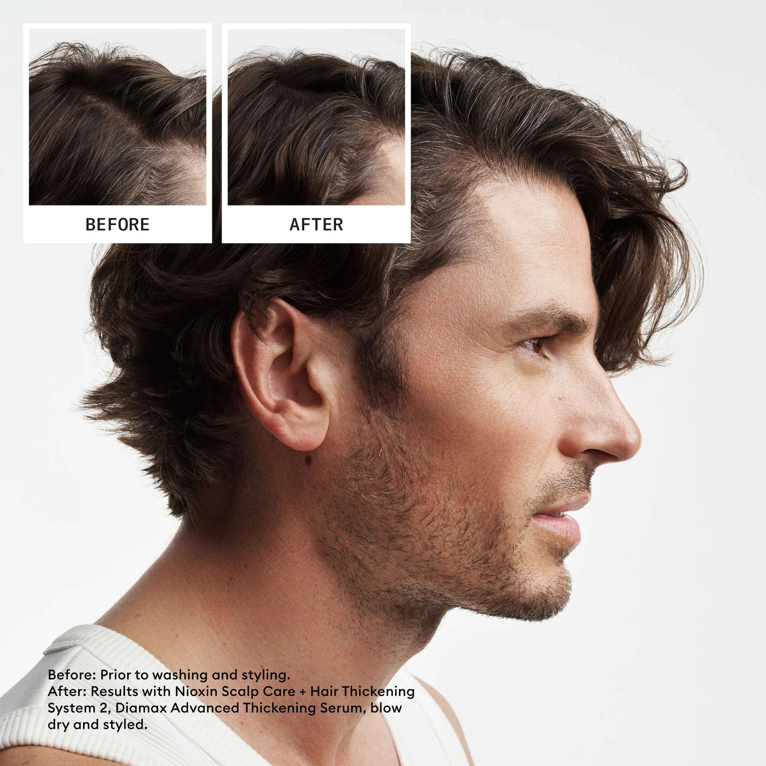 Nioxin Scalp + Hair Thickening System 2 - Includes Shampoo, Conditioner and Scalp Treatment